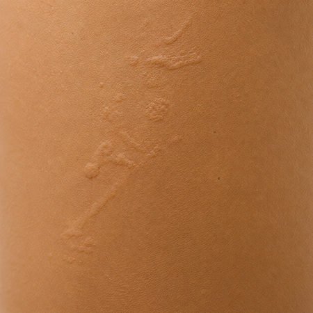urtikarija2